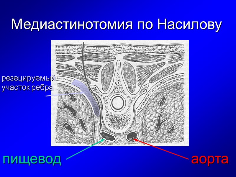 Медиастинотомия по Насилову аорта пищевод резецируемый участок ребра